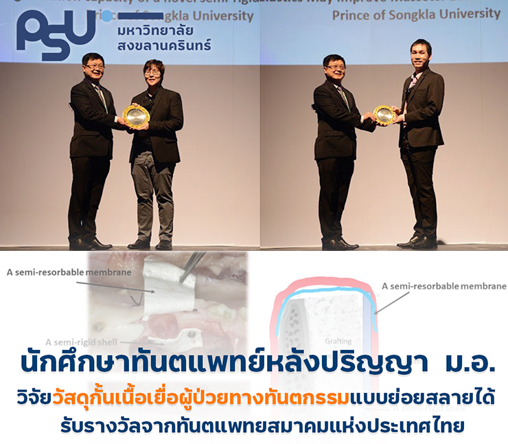 นักศึกษาทันตแพทย์หลังปริญญา ม.อ. คว้า 2 รางวัลใหญ่ จากทันตแพทยสมาคมแห่งประเทศไทย